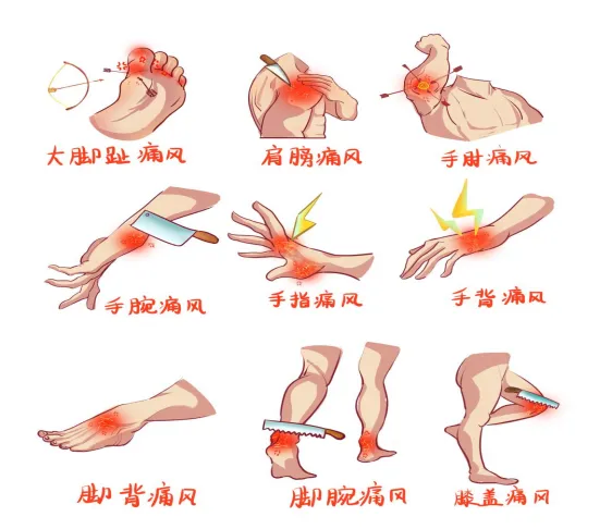 痛风的生活方式图_痛风的生活方式图_痛风的生活方式图